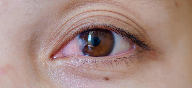 Pterygium: Causes, Symptoms And Treatment