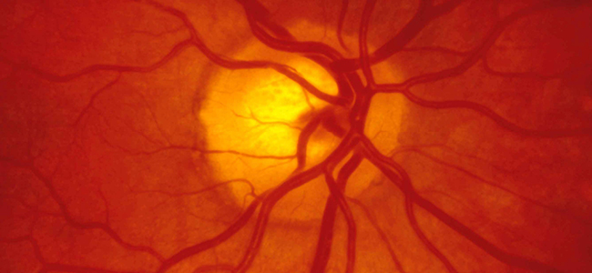 What Can You Interpret From A Retinal Photograph?